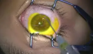 What to Expect During Corneal Crosslinking Treatment What to Expect During Corneal Crosslinking Treatment