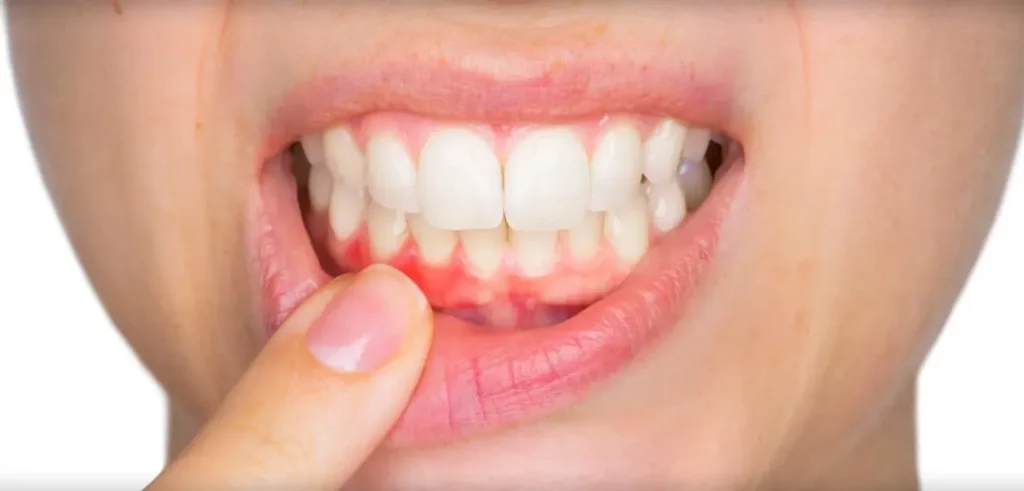 Red Flags for Your Smile: Early Signs of Gum Disease Red Flags for Your Smile Early Signs of Gum Disease